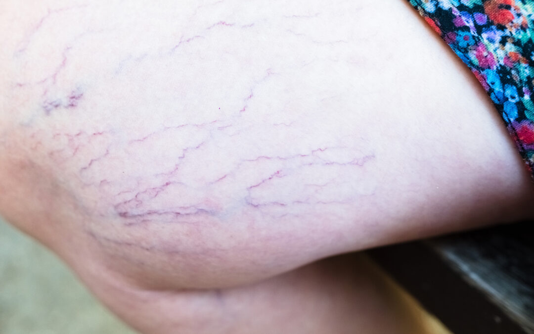 Escleroterapia en Ecuador: La Solución Definitiva para las Arañitas Vasculares