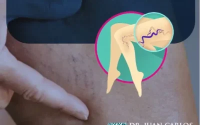 ¿Qué pasa si no se tratan las Várices?