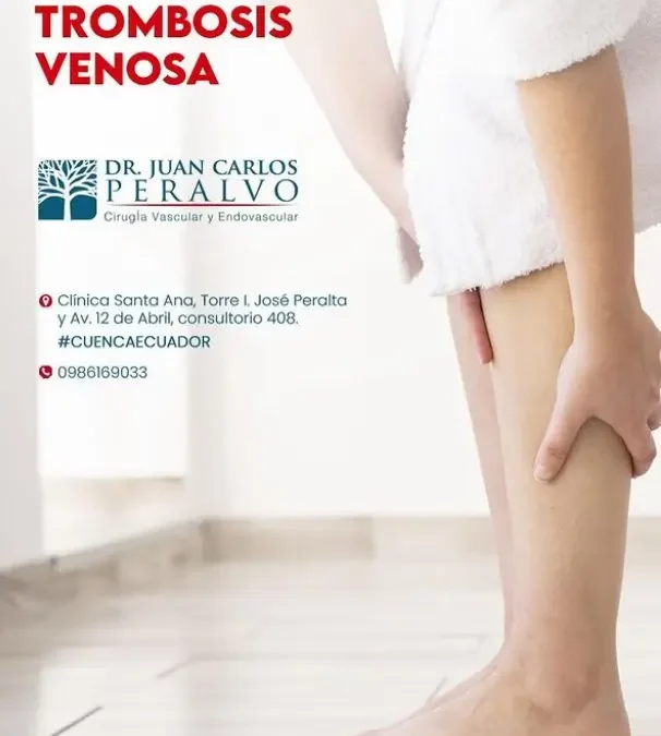 Síntomas de la Trombosis Venosa: Identificación y Tratamiento