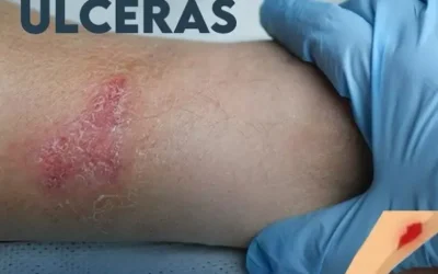 Conoce los Tipos de Úlceras y Cómo Tratarlas Eficazmente