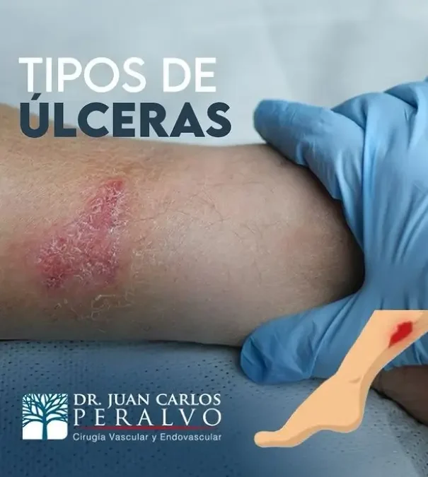 Conoce los Tipos de Úlceras y Cómo Tratarlas Eficazmente