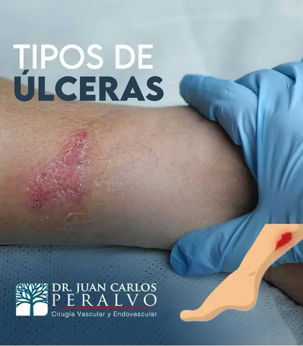 Tipos de úlcerras Dr. Juan Carlos Peralvo en Cuenca