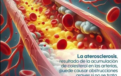 ¿Por qué se obstruyen las Arterias?