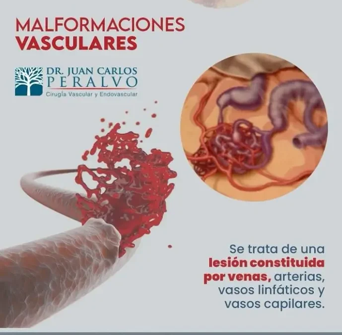 Malformaciones vasculares: Una guía completa