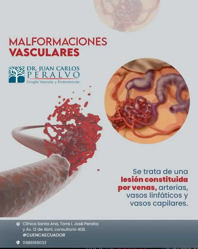 Malformaciones vasculares, Dr. Peralvo - Cirujano Vascular en Cuenca