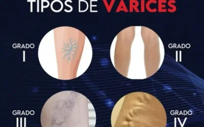 Tipos de Várices y su Evolución