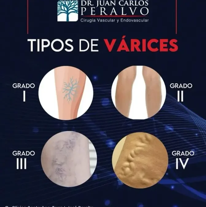 Tipos de Várices y su Evolución