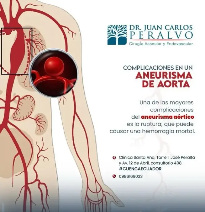 Todo sobre las Complicaciones del Aneurisma Aórtico