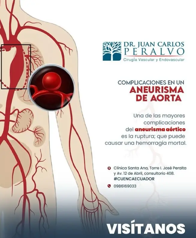 Cirujano Vascular, Dr. Juan Carlos Peralvo en la ciudad de Cuenca - Ecuador. Aneurisma de Aorta