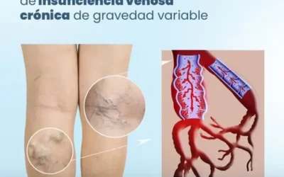 Por qué se da la Insuficiencia Venosa Crónica?