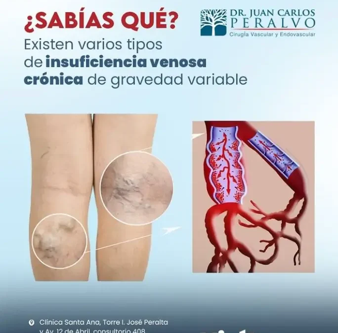 Por qué se da la Insuficiencia Venosa Crónica?