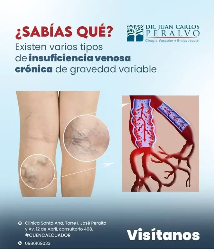 insuficiencia venosa crónica, Dr. Peralvo, Cirujano vascular, cuenca, ecuador