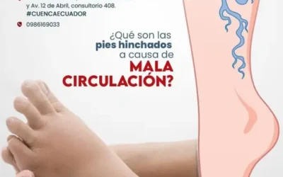 ¿Por Qué se Hinchan los Pies por Mala Circulación y Cómo Evitarlo?