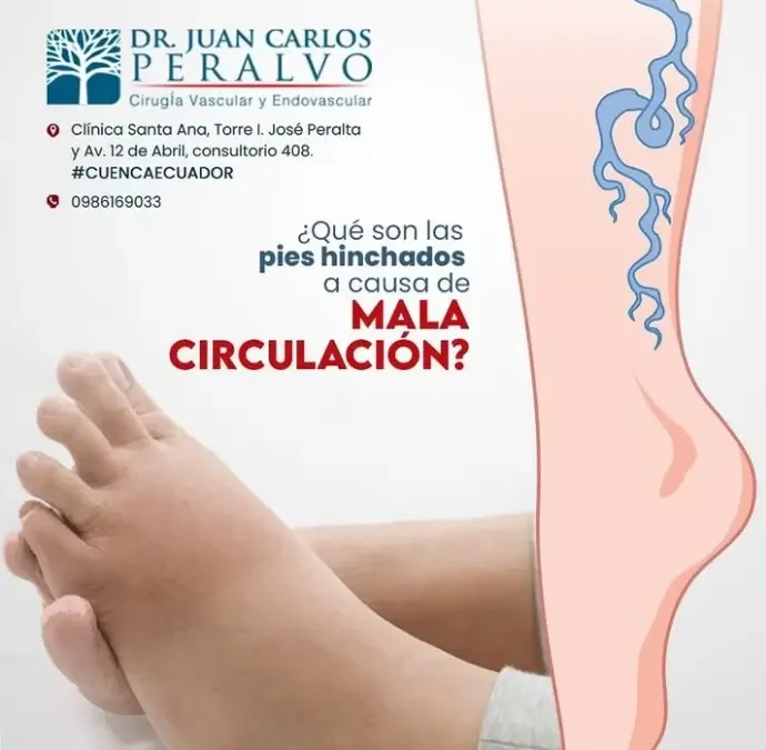 ¿Por Qué se Hinchan los Pies por Mala Circulación y Cómo Evitarlo?