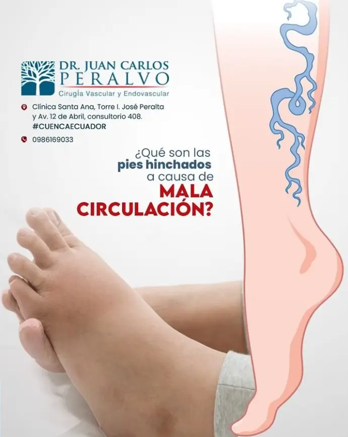 pies hinchados, mala circulación, Cuenca- Ecuador- Dr. Peralvo