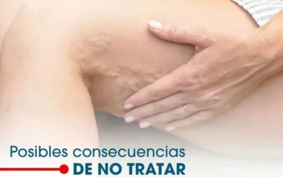 ¿Cuáles Son las Posibles Consecuencias de No Tratar las Várices?