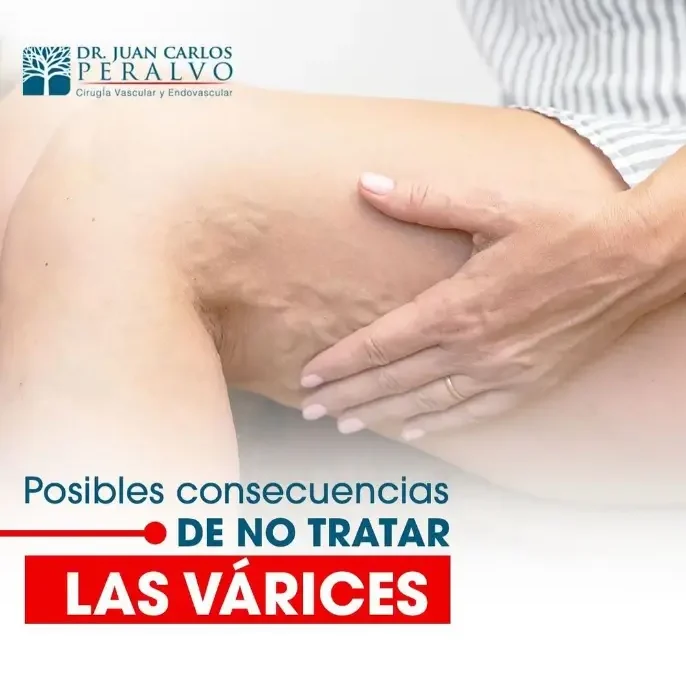 ¿Cuáles Son las Posibles Consecuencias de No Tratar las Várices?