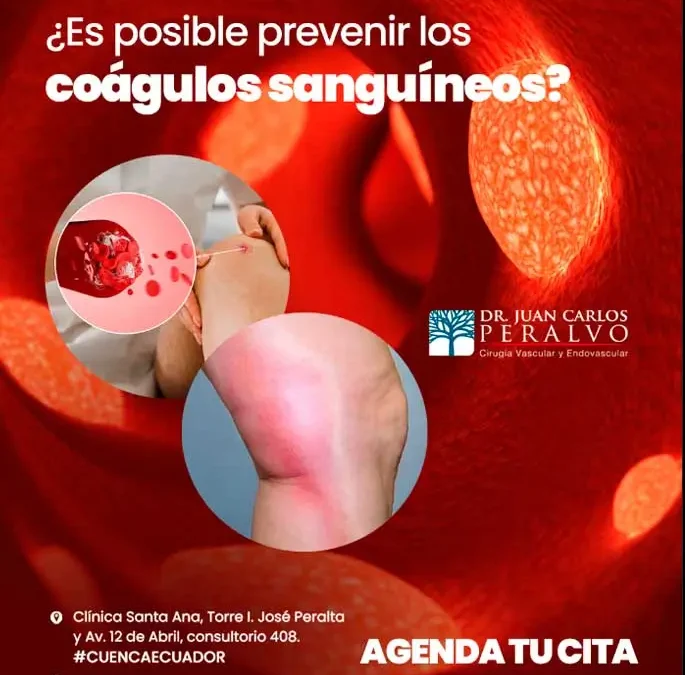 Coágulos y Problemas Cardiovasculares: ¿Qué Puedes Hacer para Evitarlos?
