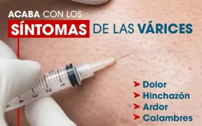 Acaba con los síntomas de las várices