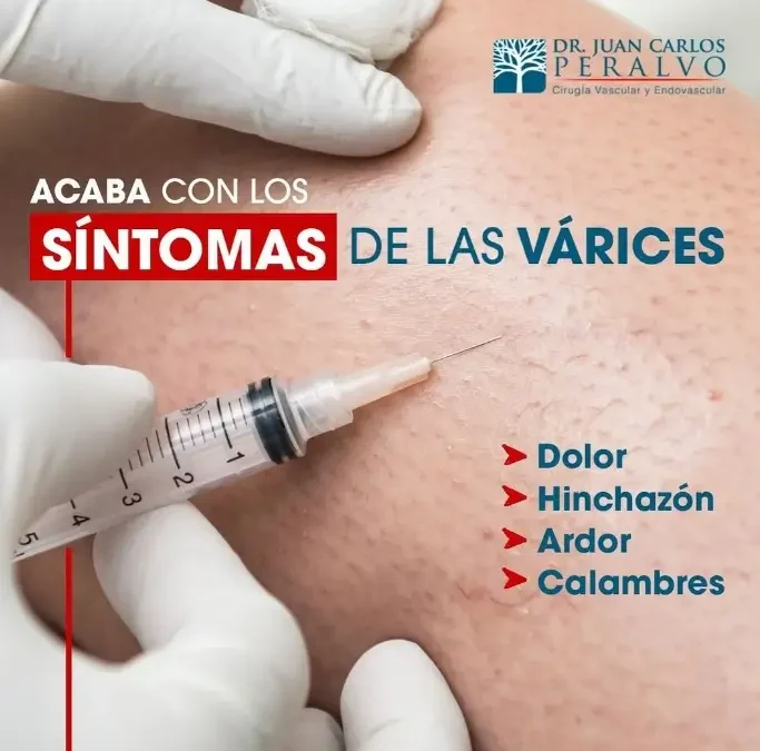 Acaba con los síntomas de las várices