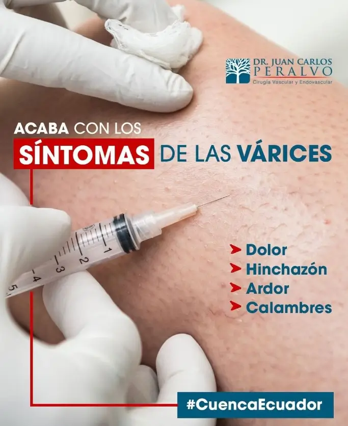 tratamiento de várices, con el Dr. Peralvo en la ciudad de cuenca ecuador