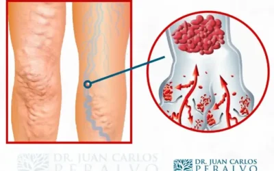 Cómo Prevenir la Inflamación Venosa: Consejos para Mantener Tus Venas Saludables