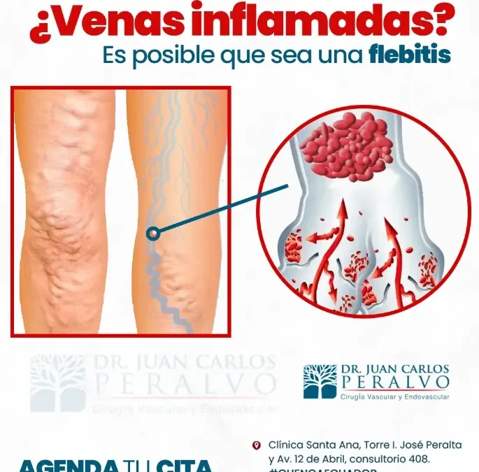 Cómo Prevenir la Inflamación Venosa: Consejos para Mantener Tus Venas Saludables