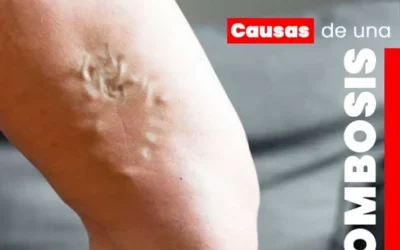 Trombosis: Ejercicios Sencillos para Mantener la Circulación y Evitar Coágulos