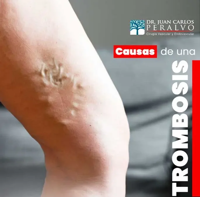 Trombosis: Ejercicios Sencillos para Mantener la Circulación y Evitar Coágulos