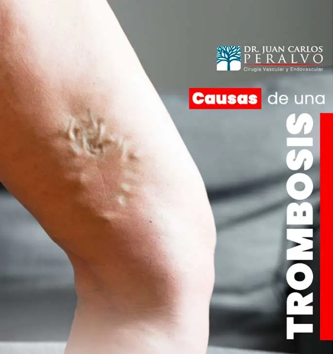 trombosis, ejercicios para la circulación, prevenir coágulos, Dr. Juan Carlos Peralvo, salud vascular, trombosis venosa profunda