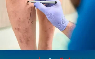 “Do Varicose Veins Go Away After Pregnancy? Everything You Need to Know”