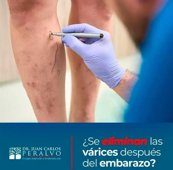 “Do Varicose Veins Go Away After Pregnancy? Everything You Need to Know”