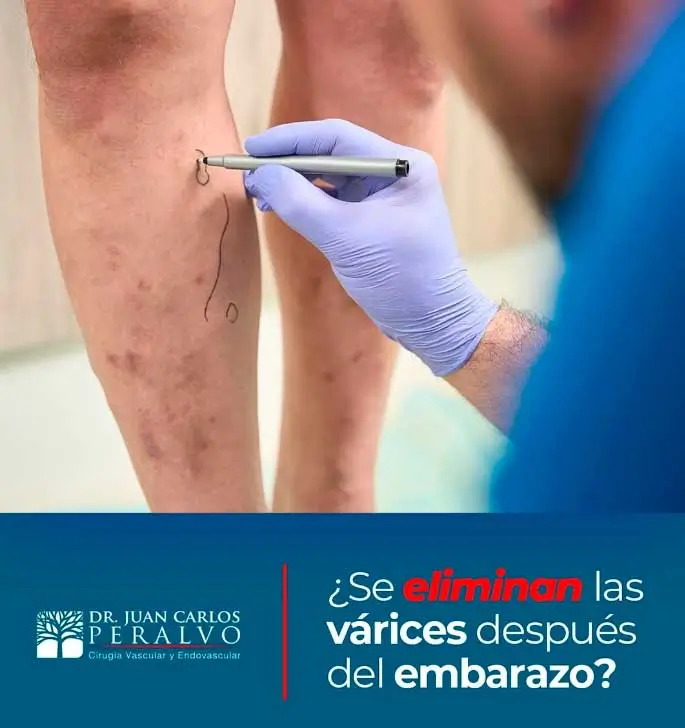 Varices en el Embarazo, Dr. Peralvo, Cirujano vascular en Cuenca-Ecuador