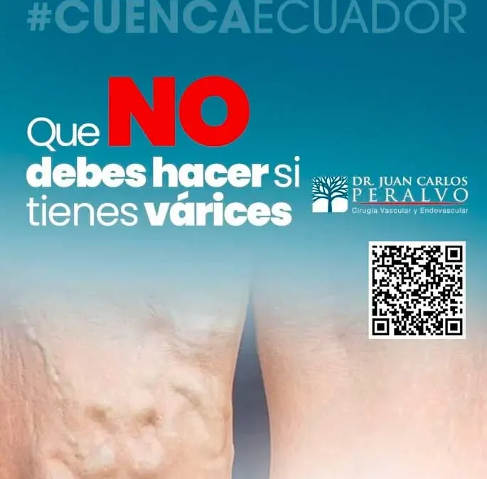 Qué NO Debes Hacer si Tienes Várices: Errores Comunes que Evitar»