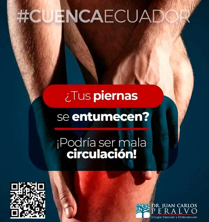varices en cuenca
