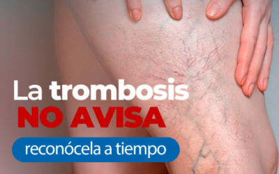 Thrombosis doesn’t warn you, recognize it in time: Symptoms, Causes, and Treatments