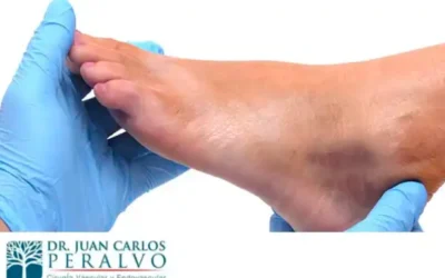 Diabetic Foot: How to Prevent and Treat This Serious Complication