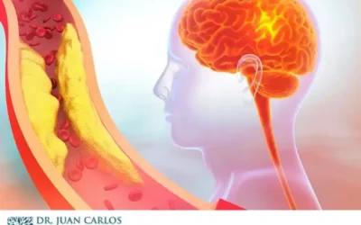Especialista Vascular: Prevención de Infartos Cerebrales
