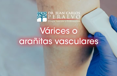 Varicose Veins or Just Spider Veins? Don’t Ignore the Signs