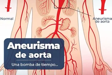 Aneurysm: The Silent Threat to Your Arteries