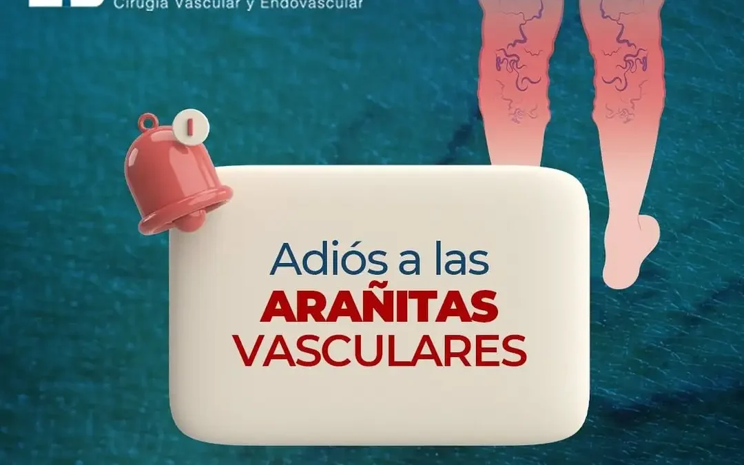 Did you know removing spider veins improves your circulation?