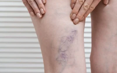 Deep Vein Thrombosis: Symptoms, Diagnosis, and Treatment
