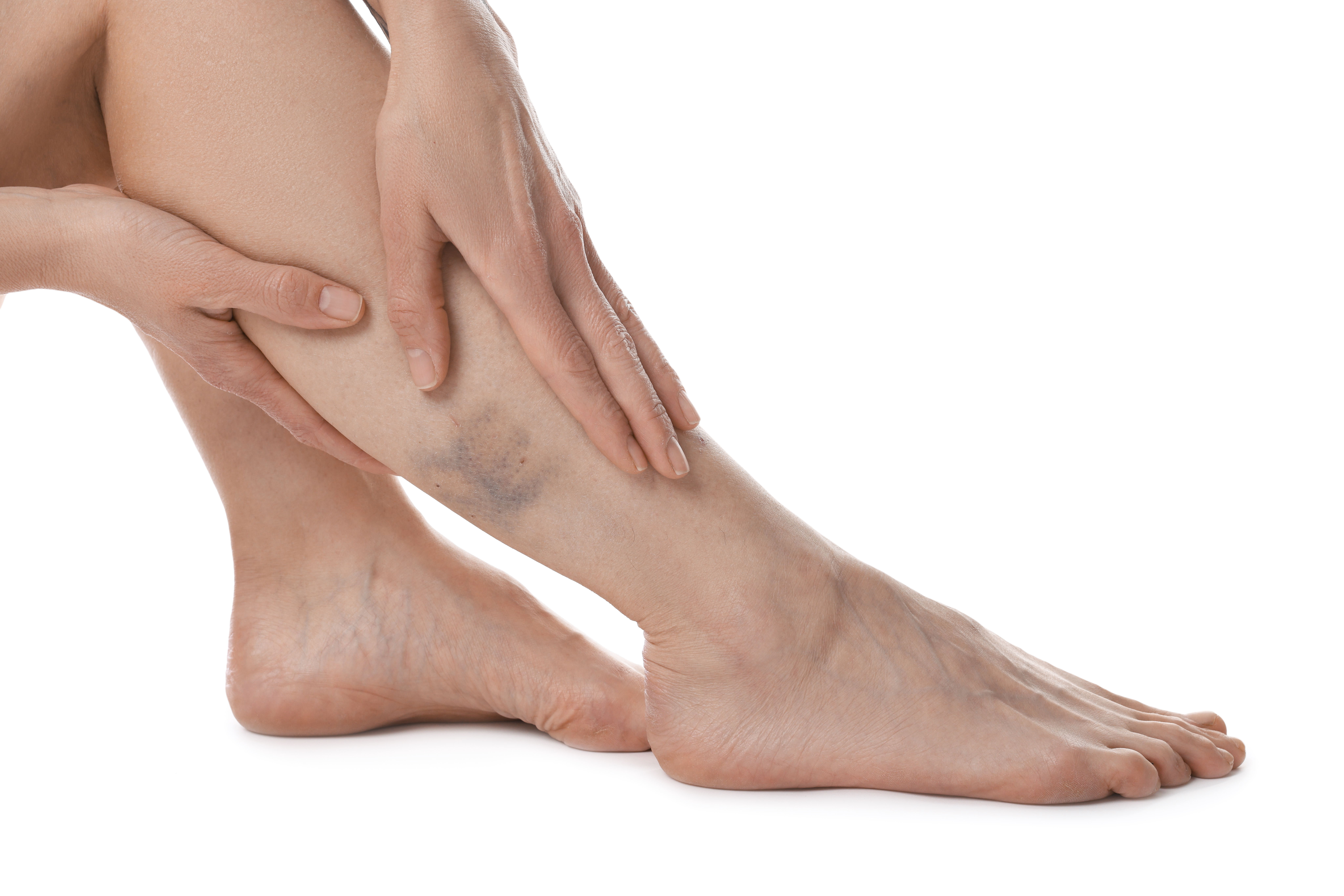 Removing Spider Veins Improves Circulation: Safe, Non-Surgical Treatments