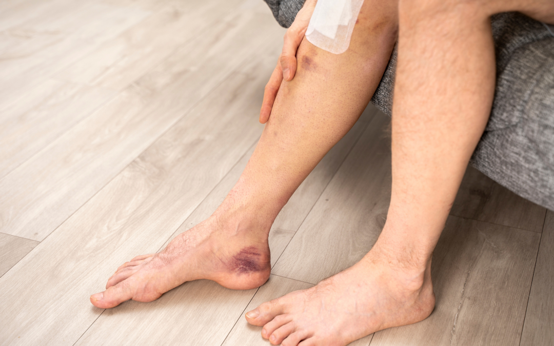 ¿Sabías que la mala circulación puede afectar tu vida diaria?