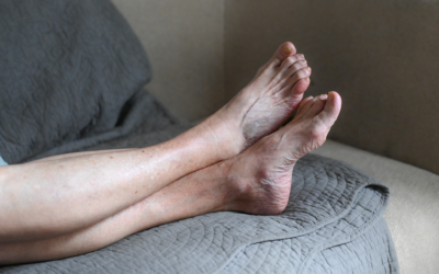 Do your legs feel heavy or swollen in hot weather?