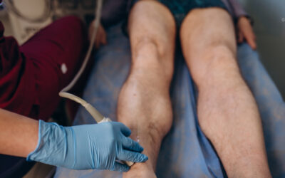 Tratamiento de Várices en Cuenca