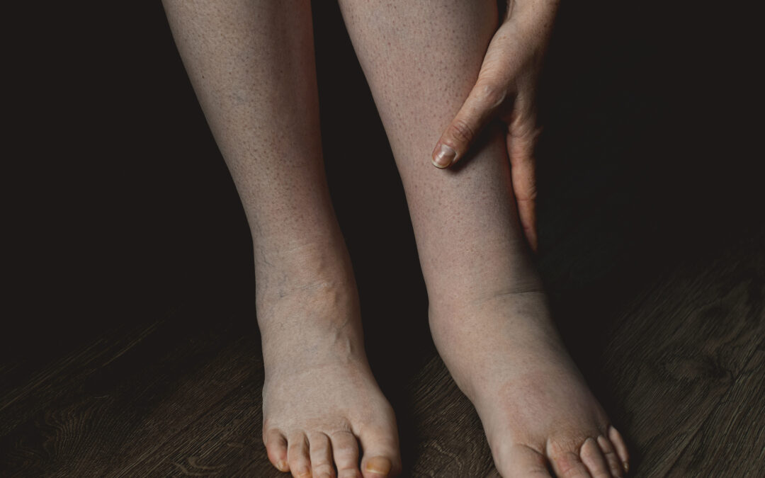 Piernas Hinchadas: Causas y Tratamiento en Ecuador