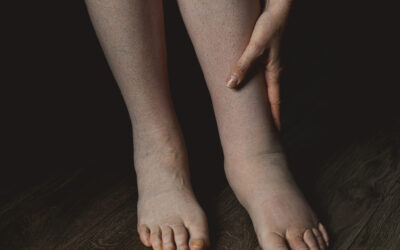 Swollen Legs: Causes & Treatment in Ecuador