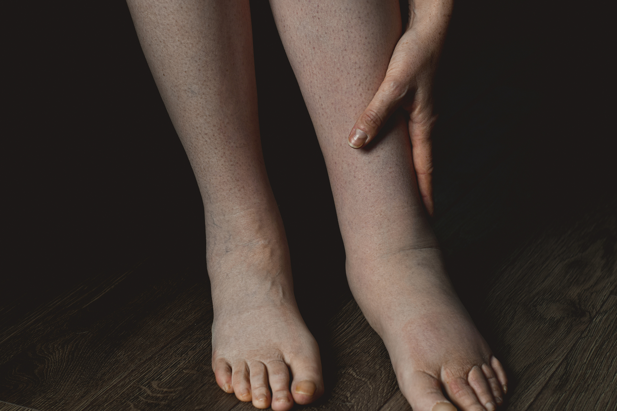 Enfermedad vascular en piernas — diagnóstico y tratamiento Dr. Peralvo Cuenca