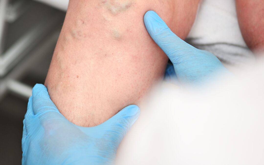 Tratamientos avanzados para varices y salud vascular en Ecuador
